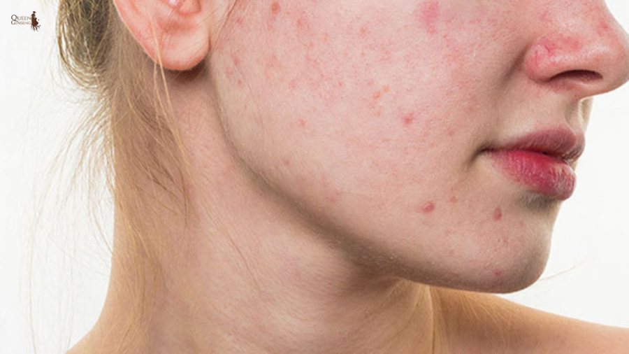 Nội tiết tố nữ ảnh hưởng đến làn da như thế nào