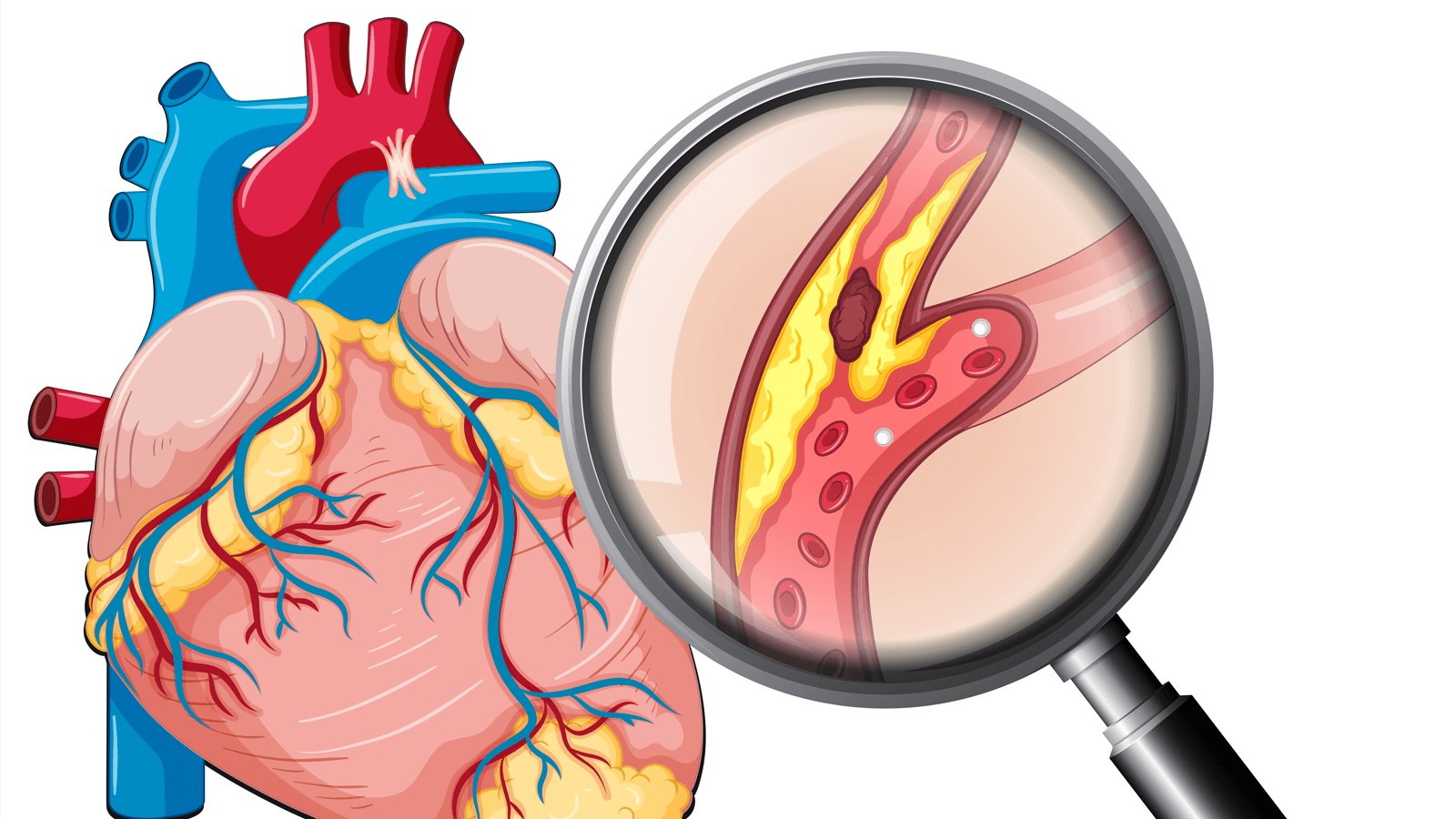 Người bị cao huyết áp và các bệnh tim mạch cấp tính